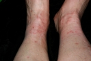 bites