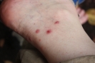 chigger bites